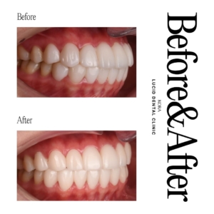 Dental retreatment 3