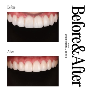 Dental retreatment 4