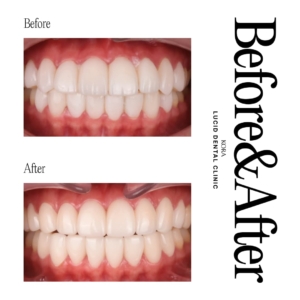 Dental retreatment