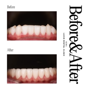 Dental retreatment 4