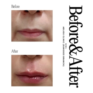 Abijou Clinic (Gangseo branch)_Lip fillers