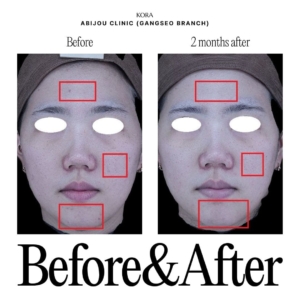 Abijou Clinic (Gangseo branch)_Skin-booster