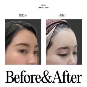 Dr. Jong Woo Yoon_Forehead filler
