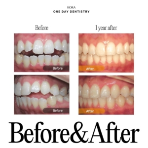 ONE DAY Dentistry Invisalign Treatment 2