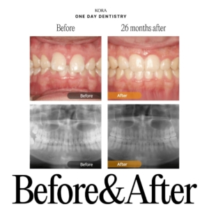 ONE DAY Dentistry Invisalign Treatment 1