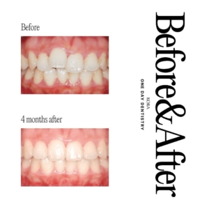 ONE DAY Dentistry Maxillary Anterior Partial Orthodontic Treatment