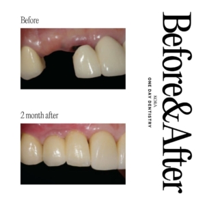 ONE DAY Dentistry before and after Dental Implant 2