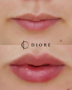 diore BA2
