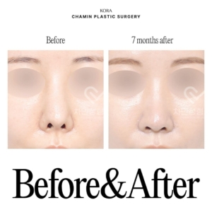 Dr. Sung Kee Min_Revision rhinoplasty 2