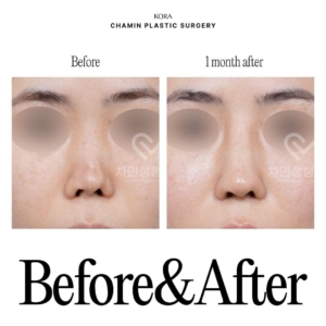 Dr. Sung Kee Min_Autologous rib cartilage revision rhinoplasty 2