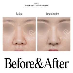Dr. Sung Kee Min_Autologous rib cartilage revision rhinoplasty 3