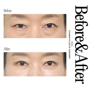 Dr. Wook Soo Chae_Upper blepharoplasty, Lower blepharoplasty