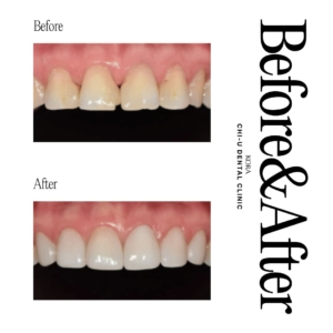 Gangnam Chi-U Dental Clinic_Dental veneers 2