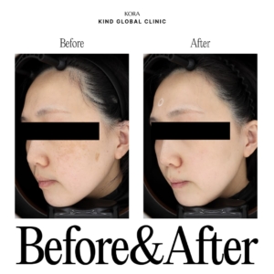 Dark Spot Removal (PicoCare)