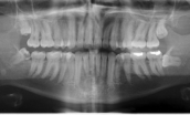 Dental panoramic X-ray for implant bone graft planning