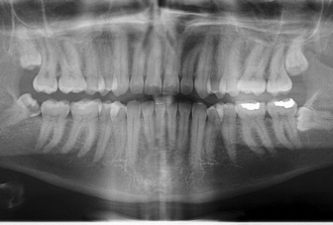 Dental panoramic X-ray for implant bone graft planning