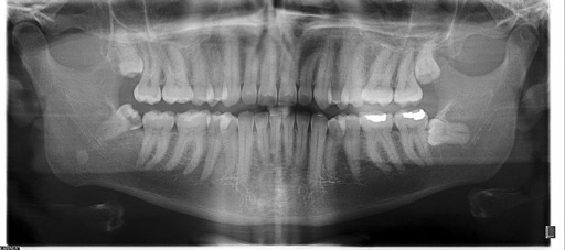 Dental panoramic X-ray for implant bone graft planning